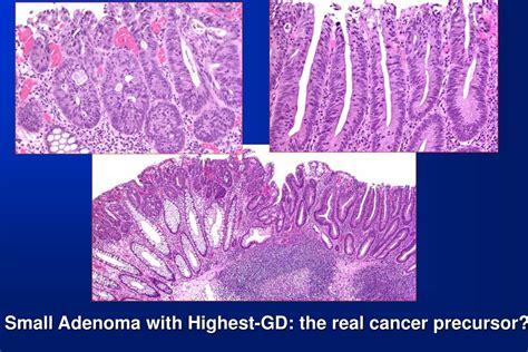 secvență adenom-carcinom secvență a tumorii colonice